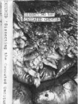 Dissecting the Caseated Omentum